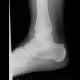 Bone cyst of calcaneus: X-ray - Plain radiograph